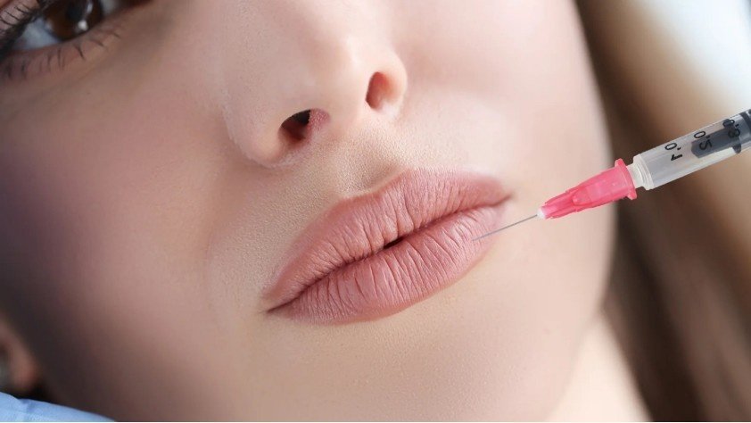 Can You Get Lip Filler While Pregnant?