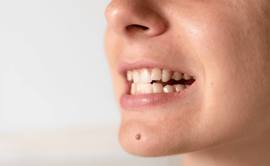 What Are Complex Malocclusions